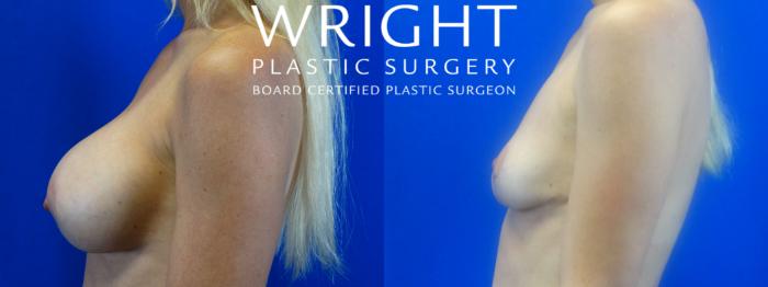 Before & After Breast Implant Removal Case 16 Left Side View in Little Rock, Arkansas