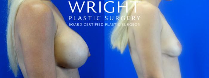 Before & After Breast Lift Case 16 Right Side View in Little Rock, Arkansas