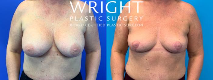 Before & After Breast Implant Removal Case 166 Front View in Little Rock, Arkansas