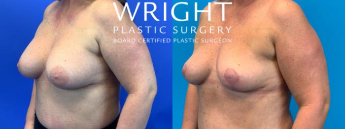 Before & After Breast Implant Removal Case 166 Left Oblique View in Little Rock, Arkansas