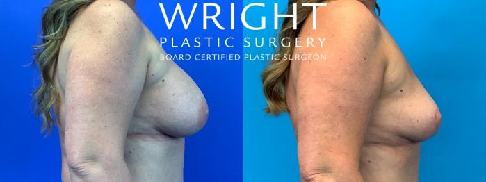 Before & After Breast Implant Removal Case 166 Right Side View in Little Rock, Arkansas