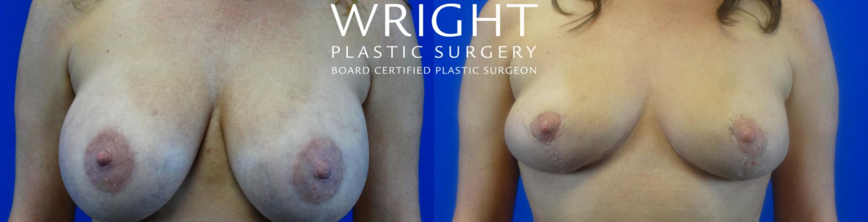 Before & After Breast Lift Case 17 Front View in Little Rock, Arkansas