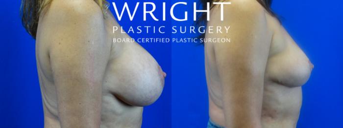 Before & After Breast Lift Case 17 Right Side View in Little Rock, Arkansas