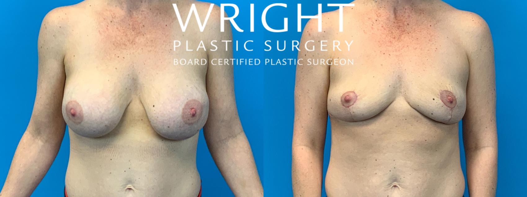 Before & After Breast Implant Removal Case 173 Front View in Little Rock, Arkansas