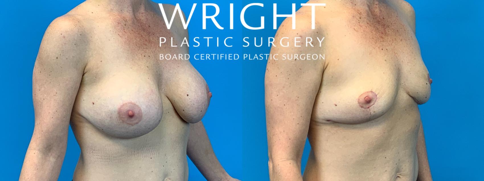 Before & After Breast Implant Removal Case 173 Right Oblique View in Little Rock, Arkansas