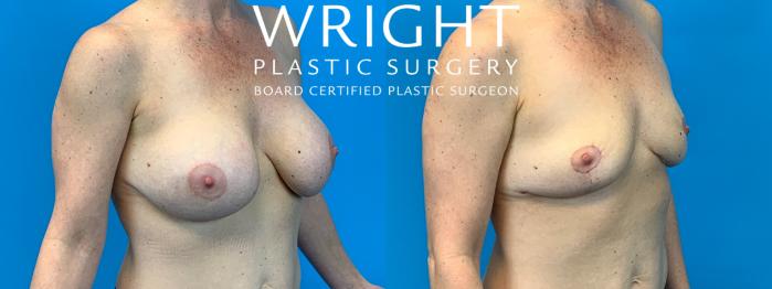 Before & After Breast Lift Case 173 Right Oblique View in Little Rock, Arkansas