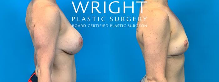 Before & After Breast Implant Removal Case 173 Right Side View in Little Rock, Arkansas