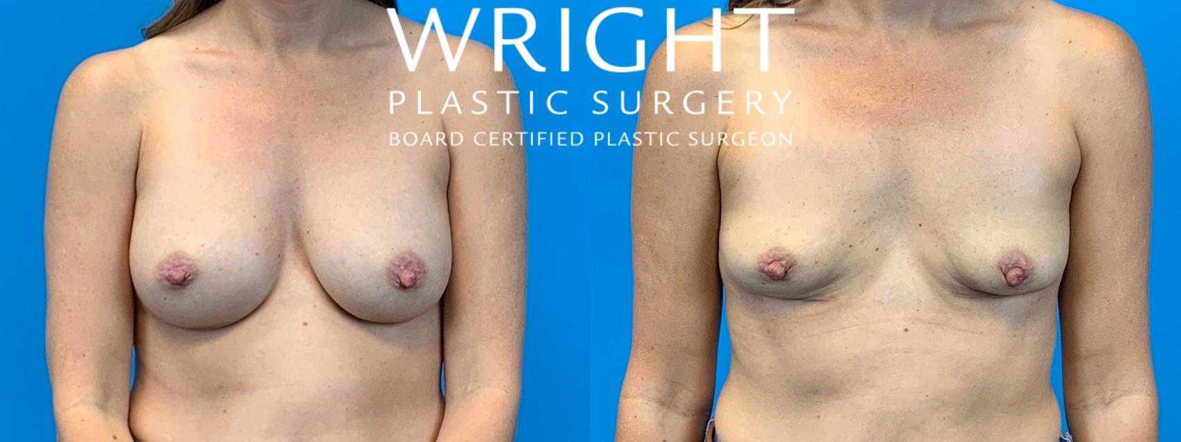 Before & After Breast Implant Removal Case 188 Front View in Little Rock, Arkansas