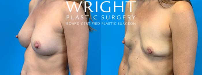 Before & After Breast Lift Case 188 Left Oblique View in Little Rock, Arkansas