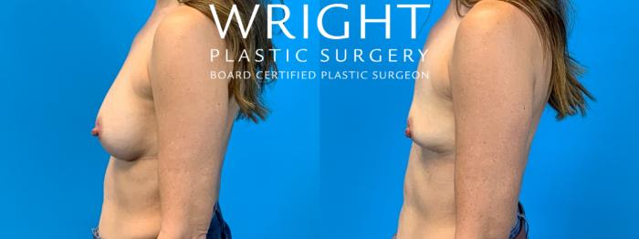 Before & After Breast Implant Removal Case 188 Left Side View in Little Rock, Arkansas