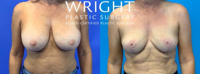 Before & After Breast Implant Removal Case 189 Front View in Little Rock, Arkansas