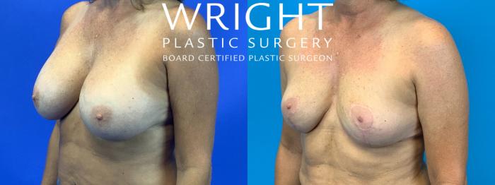 Before & After Breast Implant Removal Case 189 Left Oblique View in Little Rock, Arkansas
