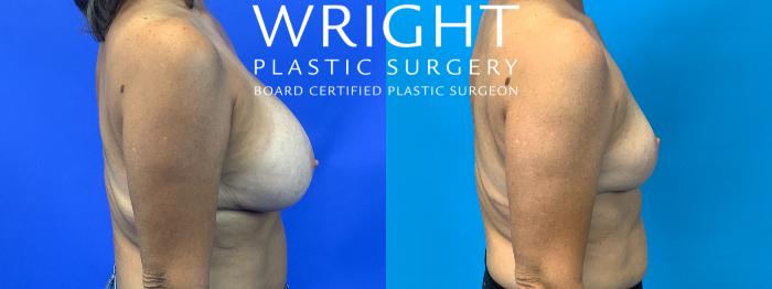 Before & After Breast Implant Removal Case 189 Right Side View in Little Rock, Arkansas