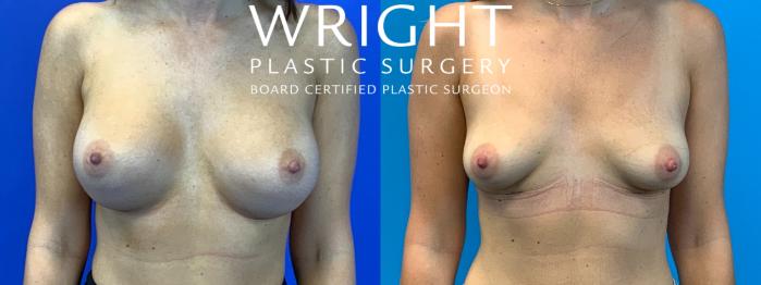 Before & After Breast Implant Removal Case 212 Front View in Little Rock, Arkansas