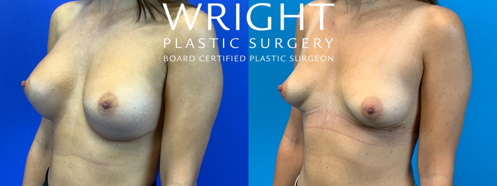 Before & After Breast Implant Removal Case 212 Left Oblique View in Little Rock, Arkansas