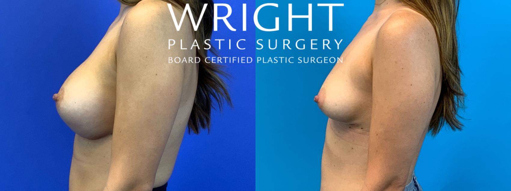 Before & After Breast Implant Removal Case 212 Left Side View in Little Rock, Arkansas