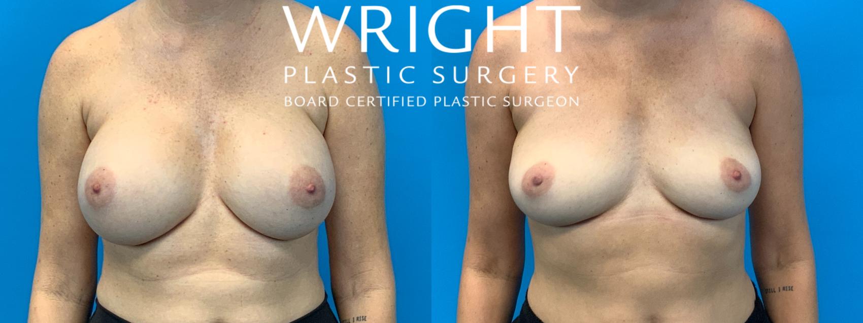 Before & After Breast Implant Removal Case 213 Front View in Little Rock, Arkansas