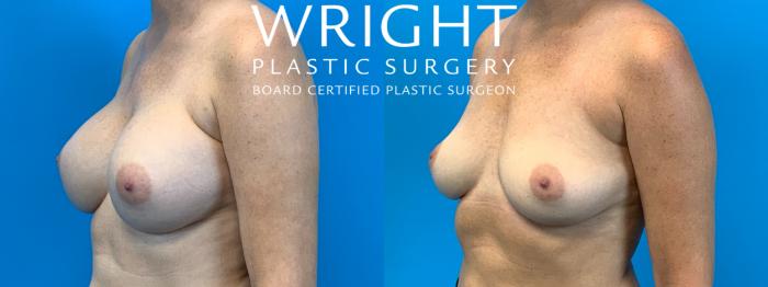 Before & After Breast Implant Removal Case 213 Left Oblique View in Little Rock, Arkansas