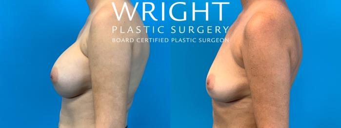 Before & After Breast Implant Removal Case 213 Left Side View in Little Rock, Arkansas