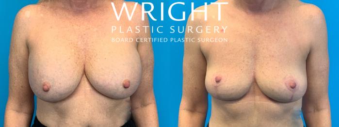 Before & After Breast Lift Case 214 Front View in Little Rock, Arkansas