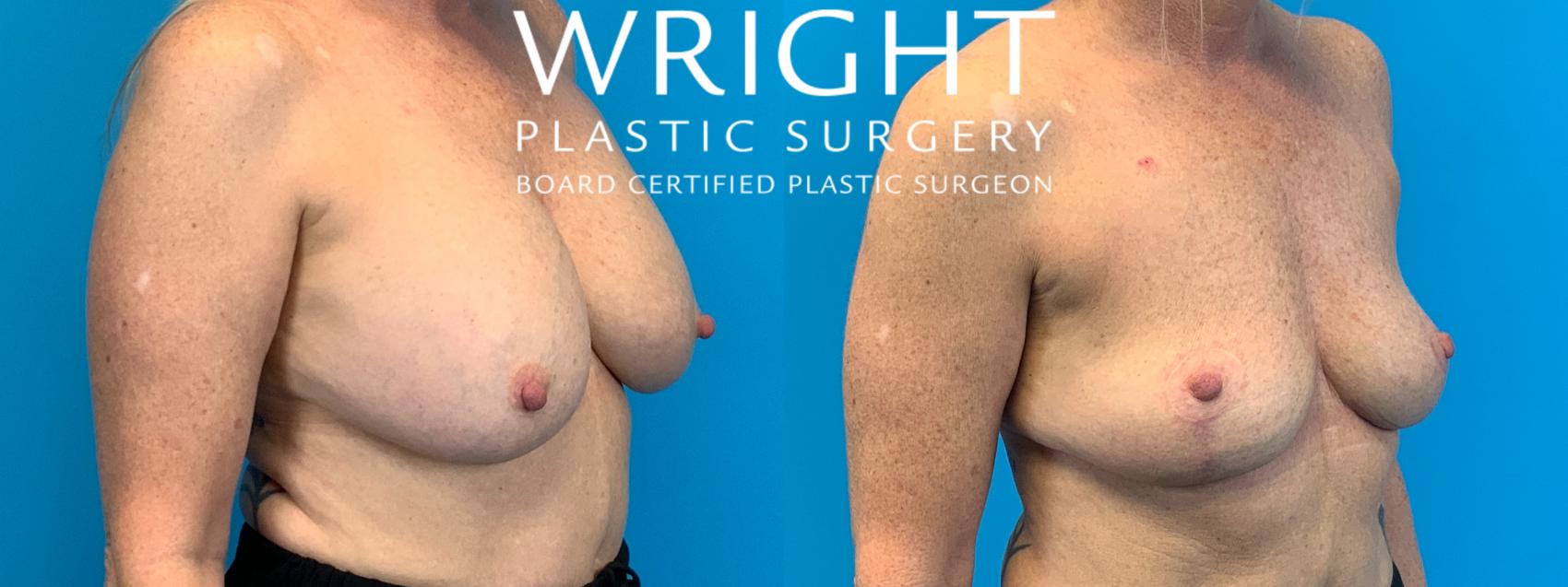 Before & After Breast Implant Removal Case 214 Right Oblique View in Little Rock, Arkansas