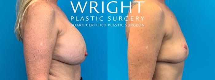 Before & After Breast Implant Removal Case 214 Right Side View in Little Rock, Arkansas