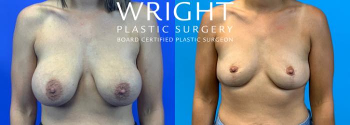 Before & After Breast Implant Removal Case 217 Front View in Little Rock, Arkansas