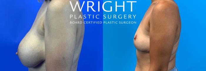 Before & After Breast Implant Removal Case 217 Left Side View in Little Rock, Arkansas