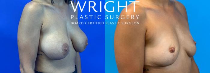 Before & After Breast Implant Removal Case 217 Right Oblique View in Little Rock, Arkansas