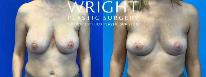 Before & After Breast Lift Case 225 Front View in Little Rock, Arkansas