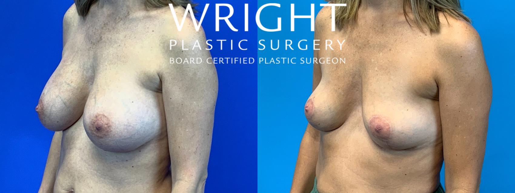 Before & After Breast Lift Case 225 Left Oblique View in Little Rock, Arkansas