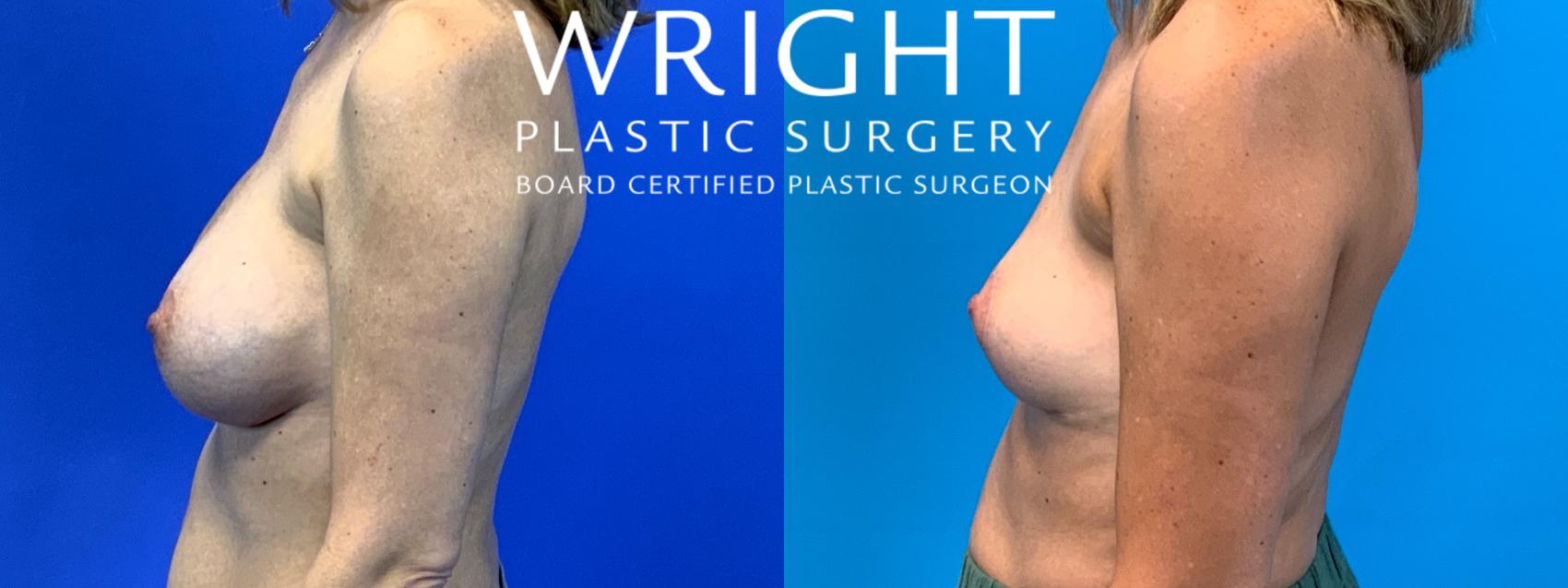 Before & After Breast Implant Removal Case 225 Left Side View in Little Rock, Arkansas