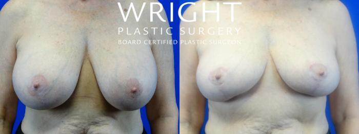 Before & After Breast Implant Removal Case 24 Front View in Little Rock, Arkansas