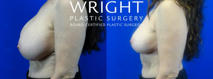 Before & After Breast Lift Case 24 Left Side View in Little Rock, Arkansas