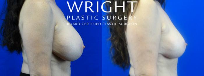 Before & After Breast Lift Case 24 Right Side View in Little Rock, Arkansas