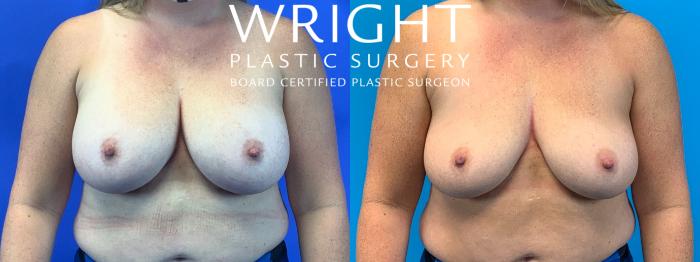 Before & After Breast Implant Removal Case 246 Front View in Little Rock, Arkansas