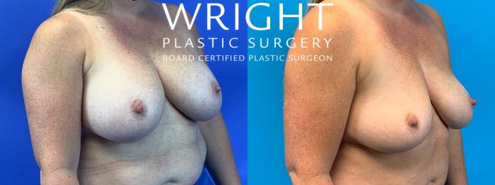 Before & After Breast Implant Removal Case 246 Left Oblique View in Little Rock, Arkansas
