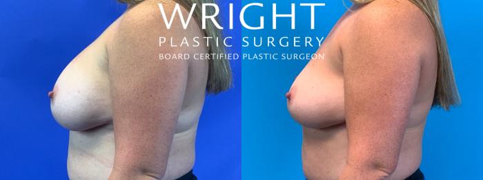 Before & After Breast Implant Removal Case 246 Left Side View in Little Rock, Arkansas