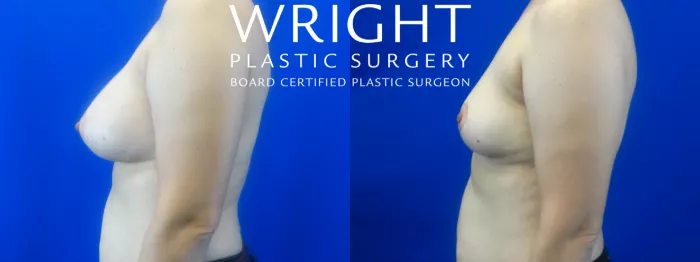 Breast Implant Removal Before and After Pictures Case 25, Little Rock,  Arkansas