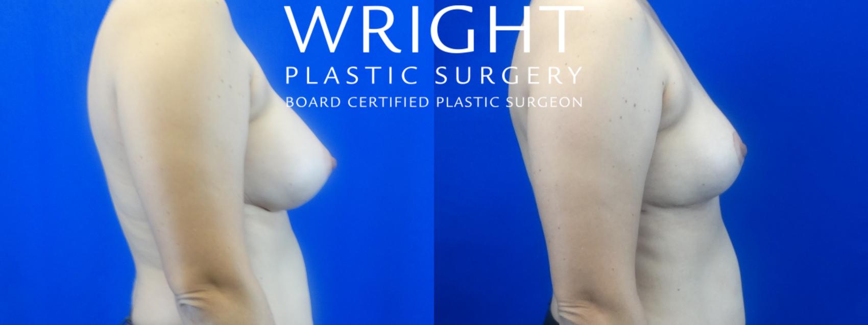 Before & After Breast Implant Removal Case 25 Right Side View in Little Rock, Arkansas