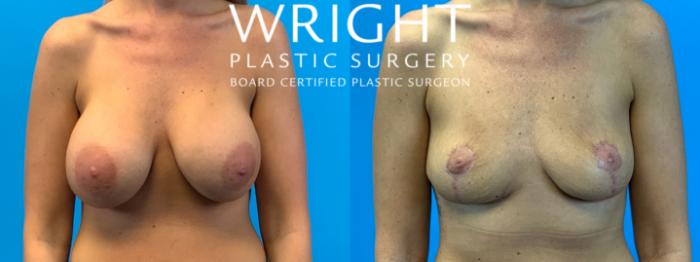 Before & After Breast Implant Removal Case 251 Front View in Little Rock, Arkansas