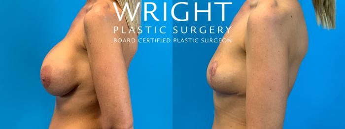 Before & After Breast Implant Removal Case 251 Left Side View in Little Rock, Arkansas