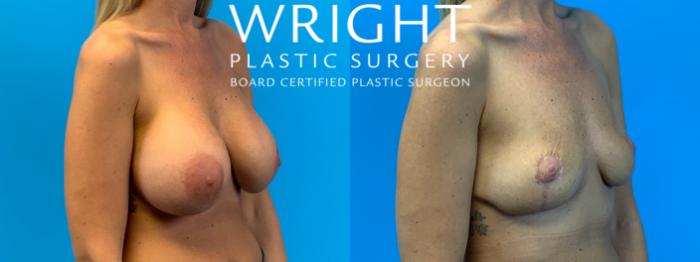 Before & After Breast Implant Removal Case 251 Right Oblique View in Little Rock, Arkansas