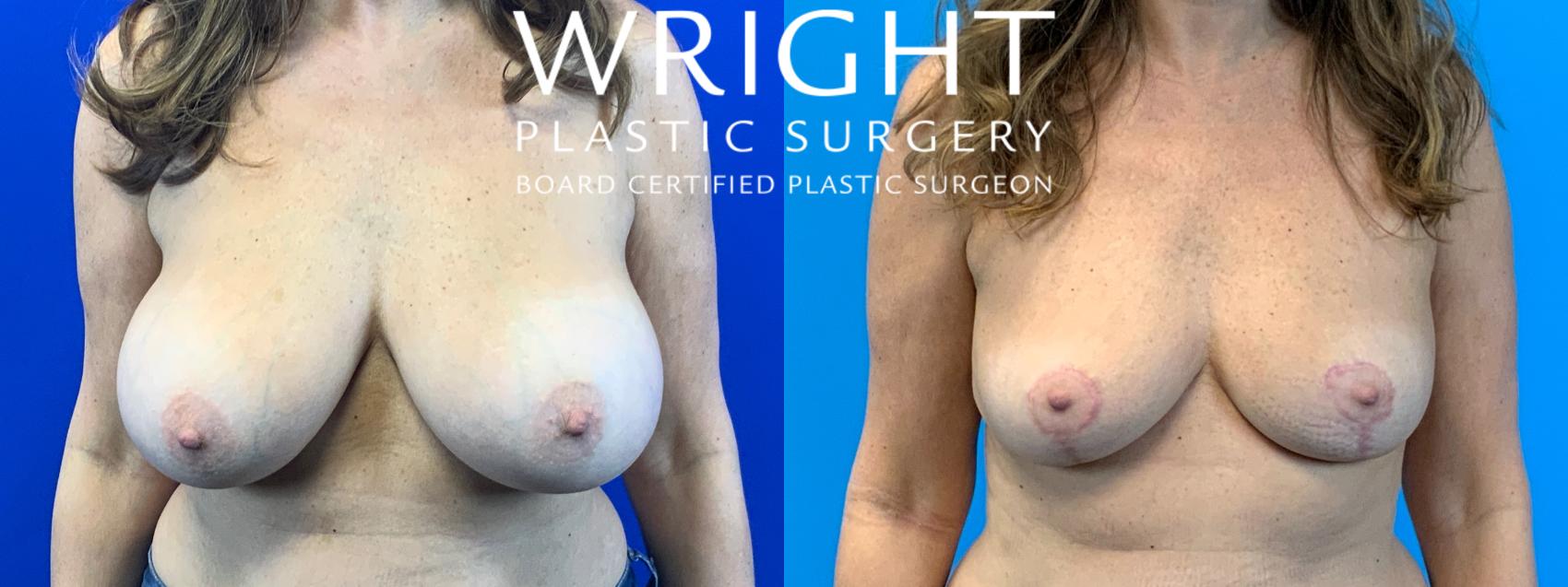 Before & After Breast Implant Removal Case 259 Front View in Little Rock, Arkansas
