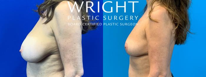 Before & After Breast Implant Removal Case 259 Left Side View in Little Rock, Arkansas