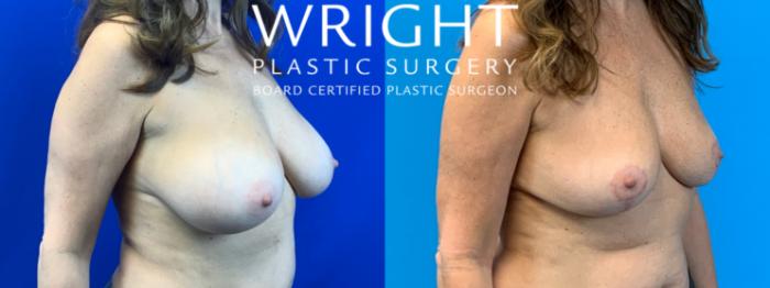 Before & After Breast Implant Removal Case 259 Right Oblique View in Little Rock, Arkansas