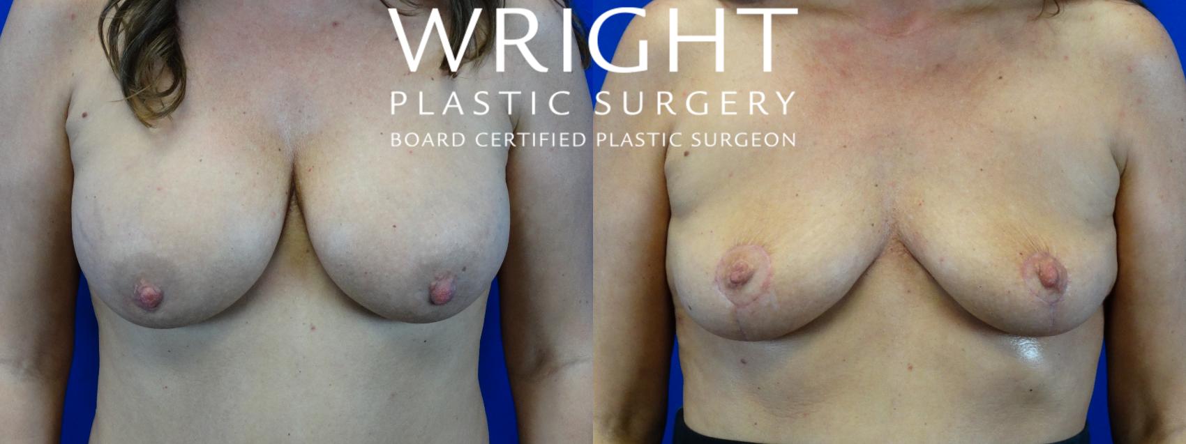 Before & After Breast Lift Case 26 Front View in Little Rock, Arkansas