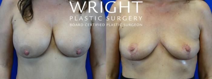 Before & After Breast Lift Case 26 Front View in Little Rock, Arkansas
