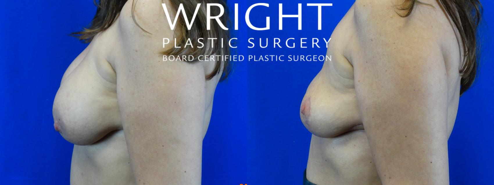 Before & After Breast Lift Case 26 Left Side View in Little Rock, Arkansas