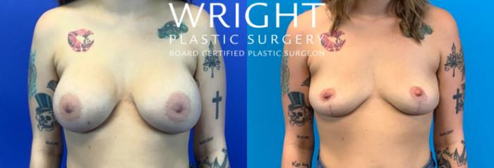 Before & After Breast Implant Removal Case 264 Front View in Little Rock, Arkansas